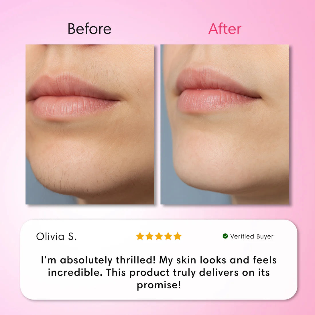Hair Removal Trilogy Kit